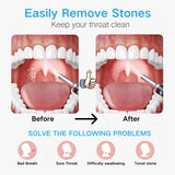 NNETM Visual Tonsil Cleaner Kit