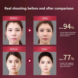 NNEOBA LED Photon Therapy Facial Lifting Massager